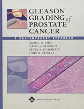 book Gleason grading of prostate cancer : a contemporary approach