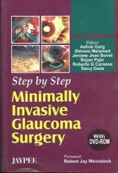 book Step by Step Minimally Invasive Cataract Surgery