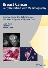 book Breast Cancer: Early Detection with Mammography: Crushed Stone-like Calcifications: The Most Frequent Malignant Type