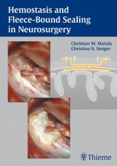 book Hemostasis and fleece-bound sealing in neurosurgery