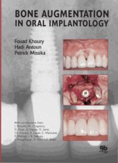 book Bone Augmentation in Oral Implantology