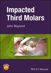 book Impacted third molars