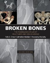 book Broken Bones: The Radiologic Atlas of Fractures and Dislocations