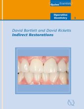 book Indirect Restorations