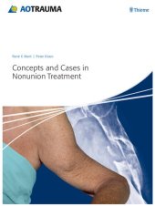 book Concepts and Cases in Nonunion Treatment