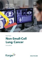 book Fast Facts: Non-Small-Cell Lung Cancer