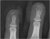 book Broken Bones: The X-Ray Atlas of Fractures