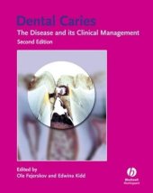 book Dental Caries: The Disease and Its Clinical Management