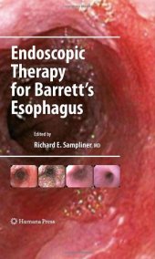 book Endoscopic Therapy for Barrett's Esophagus