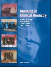 book Implants in Clinical Dentistry