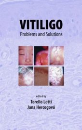 book Vitiligo: Problems and Solutions