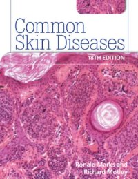 cover of the book Common Skin Diseases 18th edition