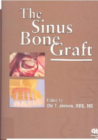 cover of the book The Sinus Bone Graft