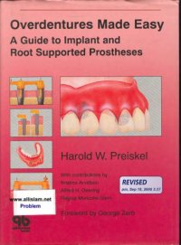 cover of the book Overdentures made easy a guide to implant and root supported prostheses