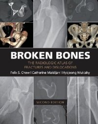 cover of the book Broken Bones: The Radiologic Atlas of Fractures and Dislocations