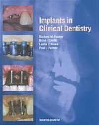 cover of the book Implants in clinical dentistry